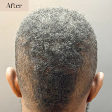 fue hair transplant fort greene after treatment image